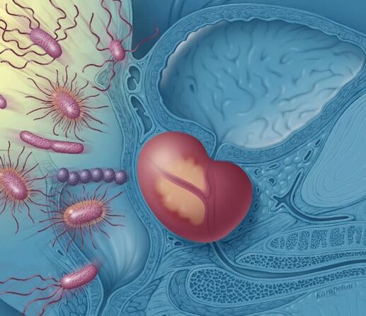 Inflammation of the prostate